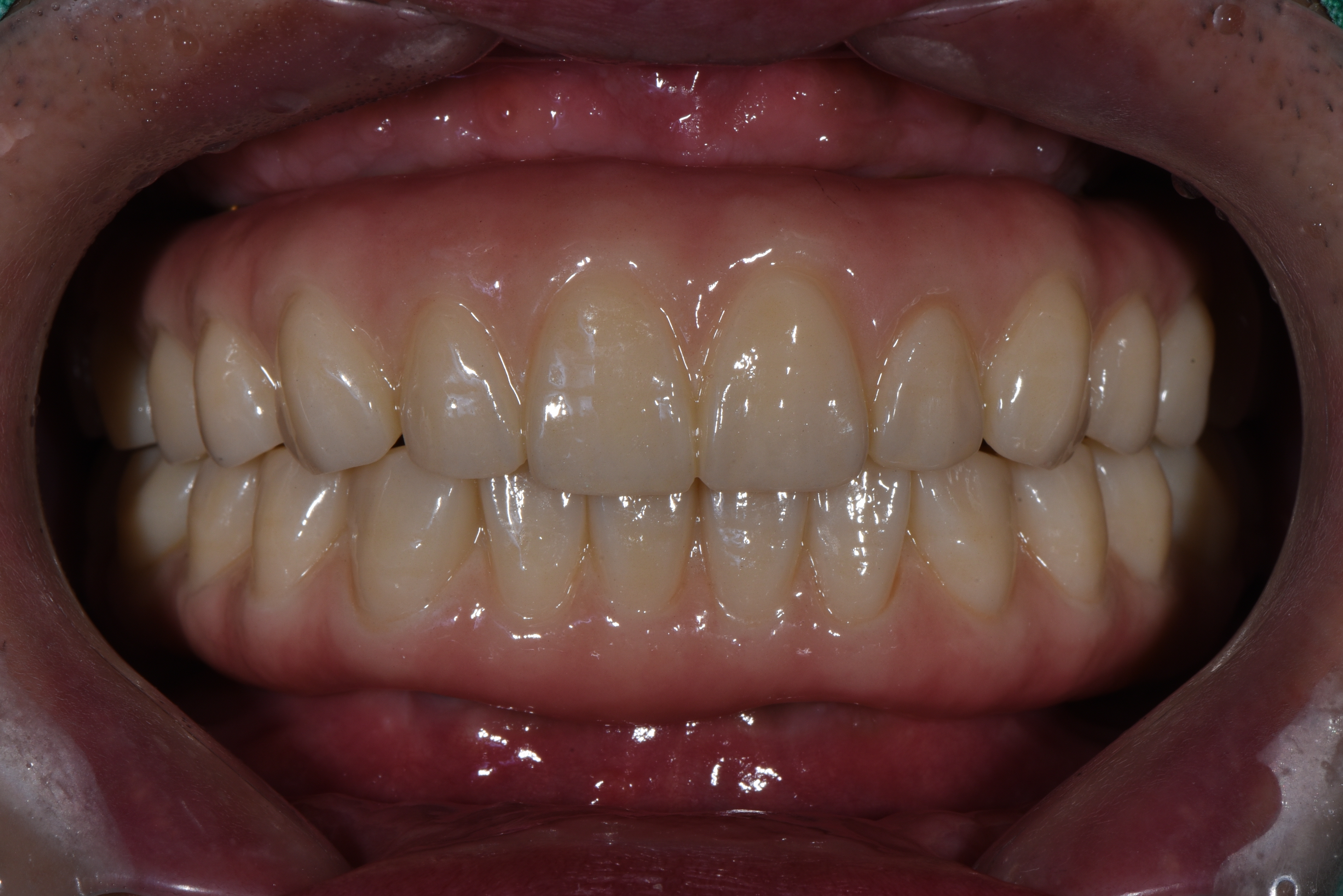 Plate 002 — prosthetic work