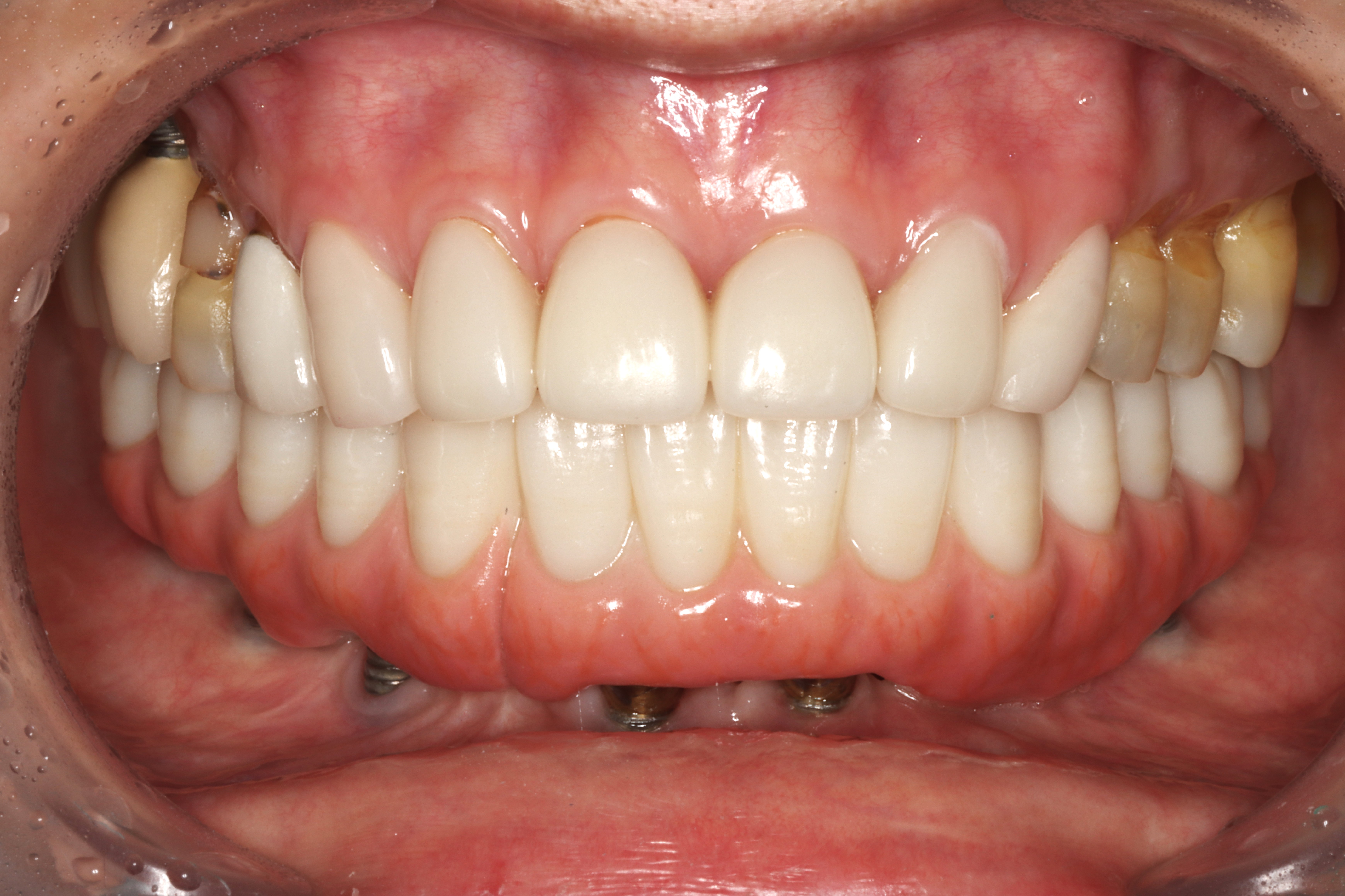 Plate 004 — prosthetic work